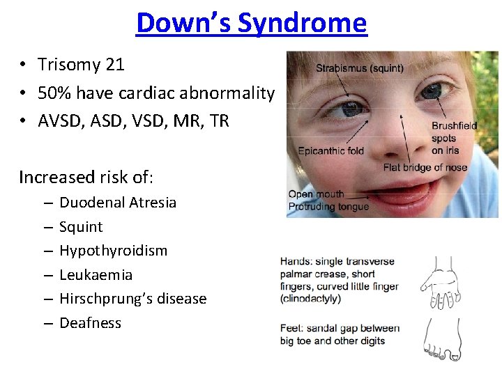 Down’s Syndrome • Trisomy 21 • 50% have cardiac abnormality • AVSD, ASD, VSD,