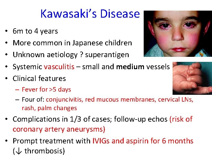 Kawasaki’s Disease • • • 6 m to 4 years More common in Japanese