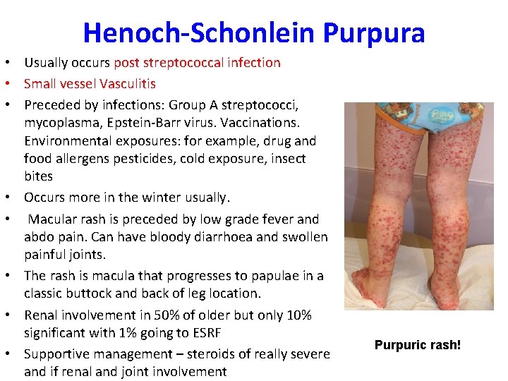 Henoch-Schonlein Purpura • Usually occurs post streptococcal infection • Small vessel Vasculitis • Preceded