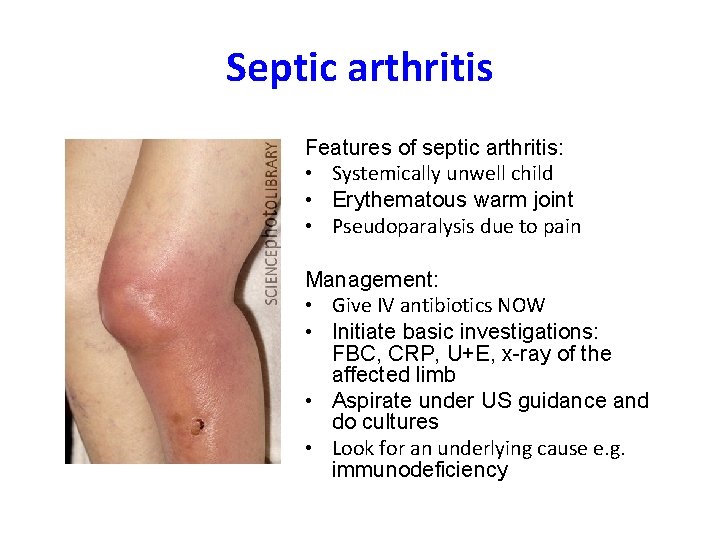 Septic arthritis Features of septic arthritis: • Systemically unwell child • Erythematous warm joint