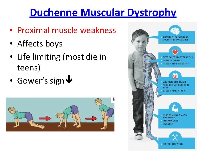 Duchenne Muscular Dystrophy • Proximal muscle weakness • Affects boys • Life limiting (most