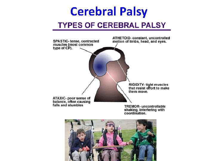 Cerebral Palsy 