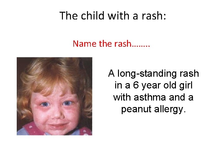 The child with a rash: Name the rash……. . A long-standing rash in a
