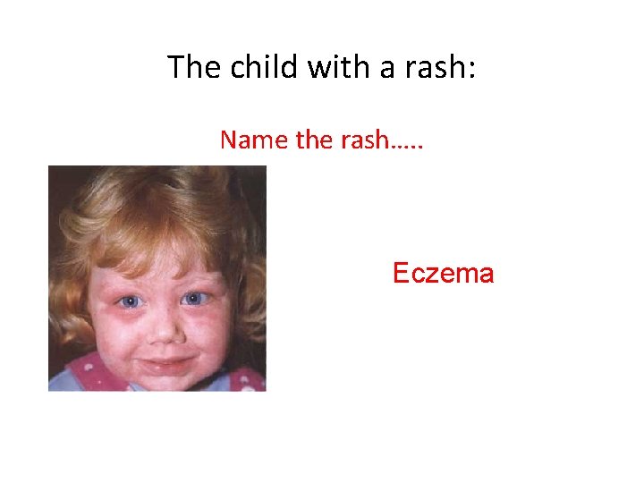 The child with a rash: Name the rash…. . Eczema 