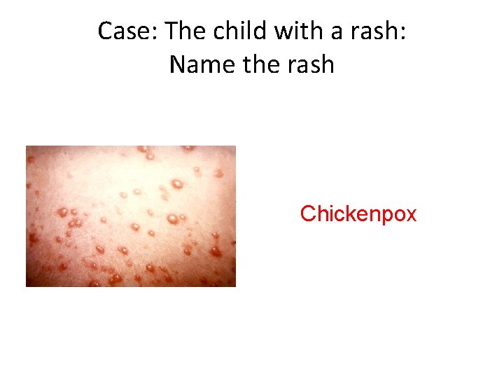 Case: The child with a rash: Name the rash Chickenpox 