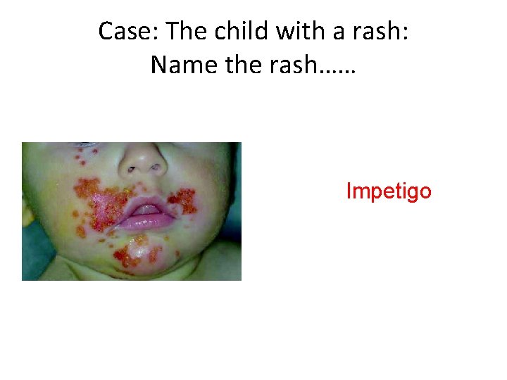 Case: The child with a rash: Name the rash…… Impetigo 