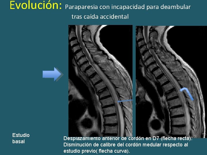 Evolución: Paraparesia con incapacidad para deambular tras caída accidental Estudio basal Desplazamiento anterior de