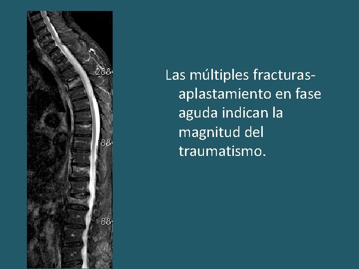 Las múltiples fracturasaplastamiento en fase aguda indican la magnitud del traumatismo. 