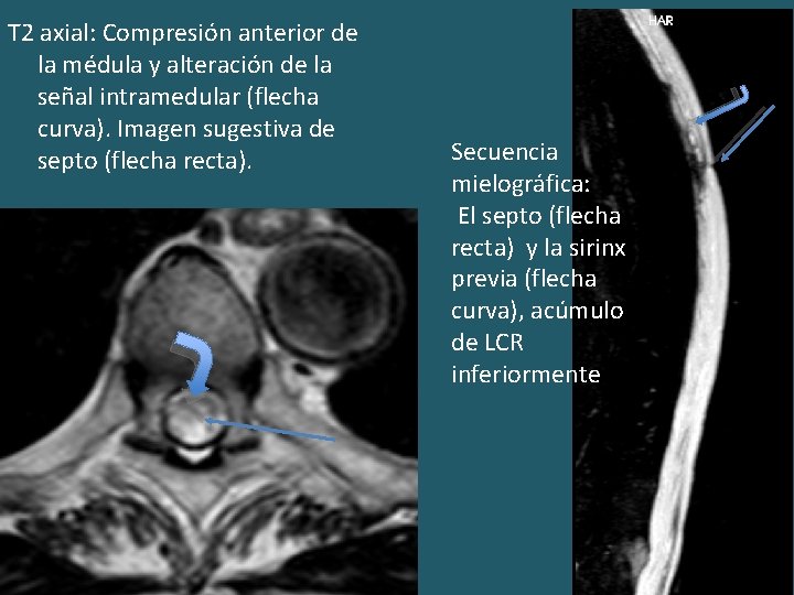 T 2 axial: Compresión anterior de la médula y alteración de la señal intramedular