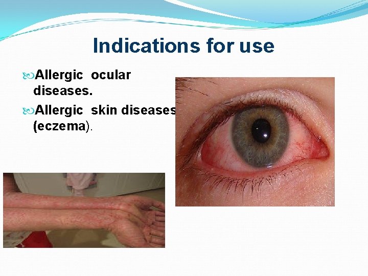 Indications for use Allergic ocular diseases. Allergic skin diseases (eczema). 