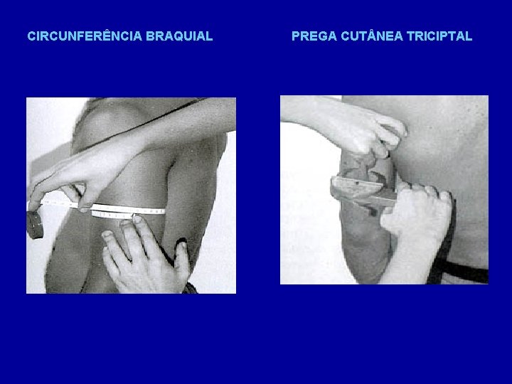 CIRCUNFERÊNCIA BRAQUIAL PREGA CUT NEA TRICIPTAL 