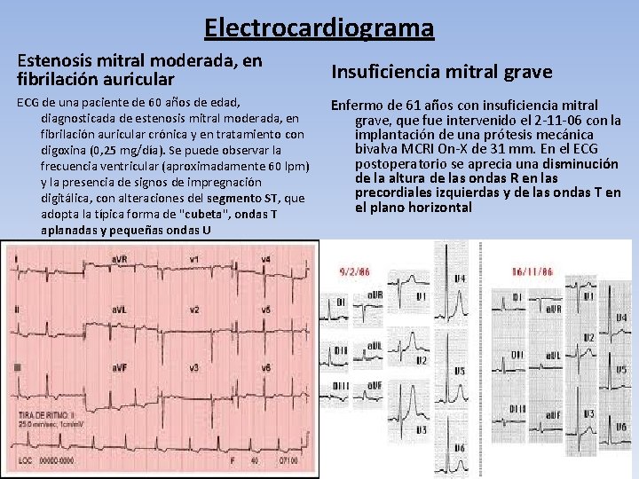 Electrocardiograma Estenosis mitral moderada, en fibrilación auricular ECG de una paciente de 60 años