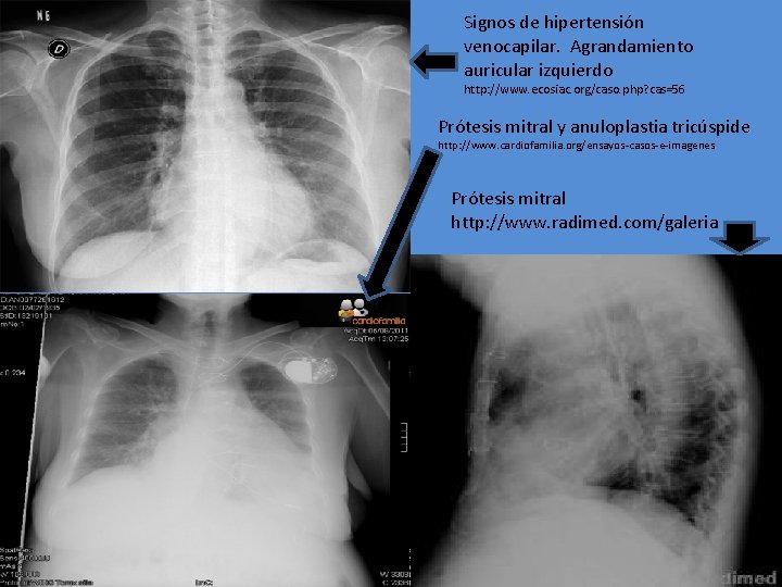 Signos de hipertensión venocapilar. Agrandamiento auricular izquierdo http: //www. ecosiac. org/caso. php? cas=56 Prótesis