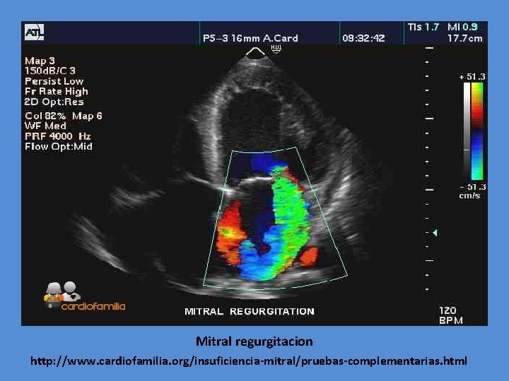 Mitral regurgitacion http: //www. cardiofamilia. org/insuficiencia-mitral/pruebas-complementarias. html 