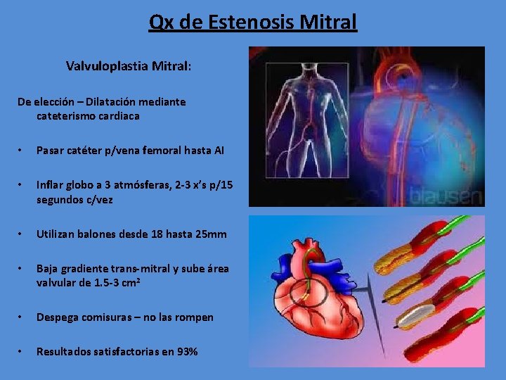 Qx de Estenosis Mitral Valvuloplastia Mitral: De elección – Dilatación mediante cateterismo cardiaca •