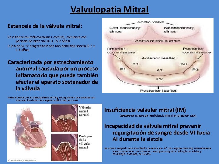 Valvulopatia Mitral Estenosis de la válvula mitral: 2 o a fiebre reumática (causa >