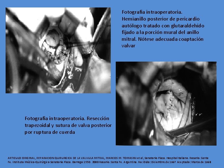 Fotografía intraoperatoria. Hemianillo posterior de pericardio autólogo tratado con glutaraldehído fijado a la porción