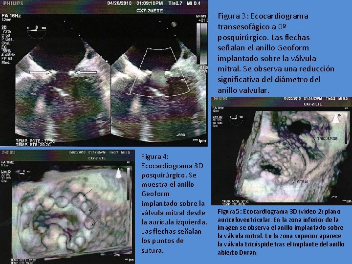 Figura 3: Ecocardiograma transesofágico a 0º posquirúrgico. Las flechas señalan el anillo Geoform implantado