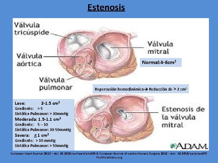 Estenosis Normal: 4 -6 cm 2 Repercusión hemodinámica Reducción de > 2 cm 2