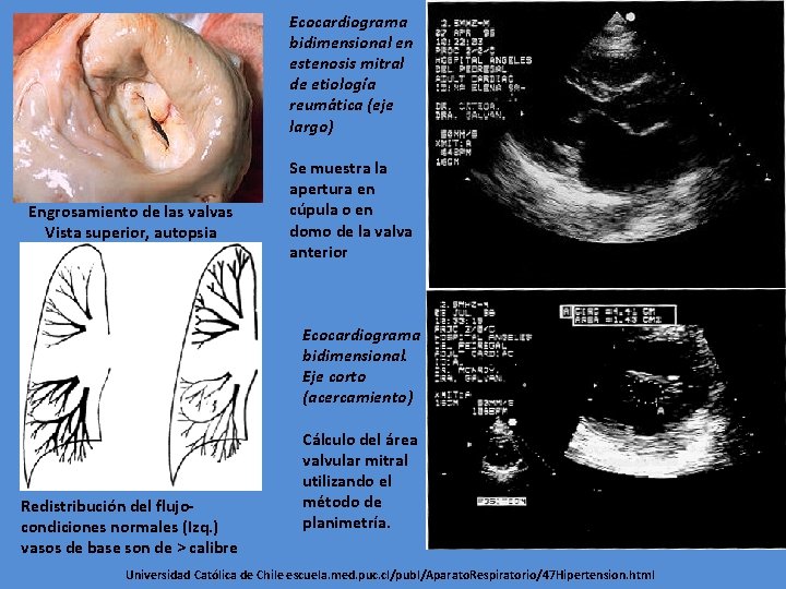 Ecocardiograma bidimensional en estenosis mitral de etiología reumática (eje largo) Engrosamiento de las valvas