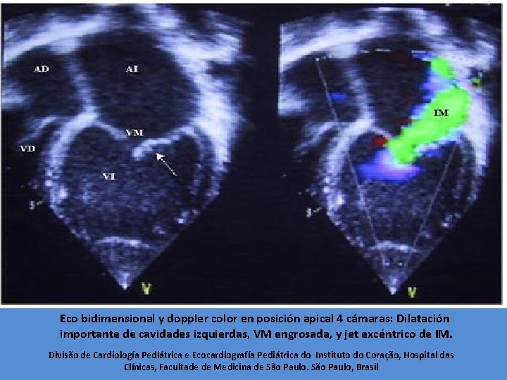 Eco bidimensional y doppler color en posición apical 4 cámaras: Dilatación importante de cavidades