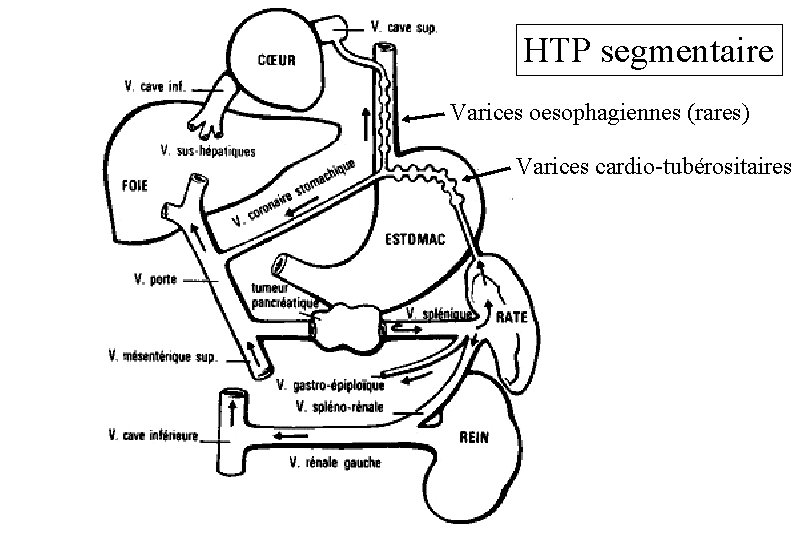 HTP segmentaire Varices oesophagiennes (rares) Varices cardio-tubérositaires 