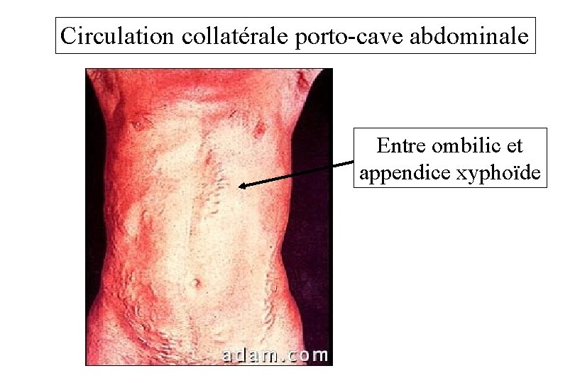 Circulation collatérale porto-cave abdominale Entre ombilic et appendice xyphoïde 