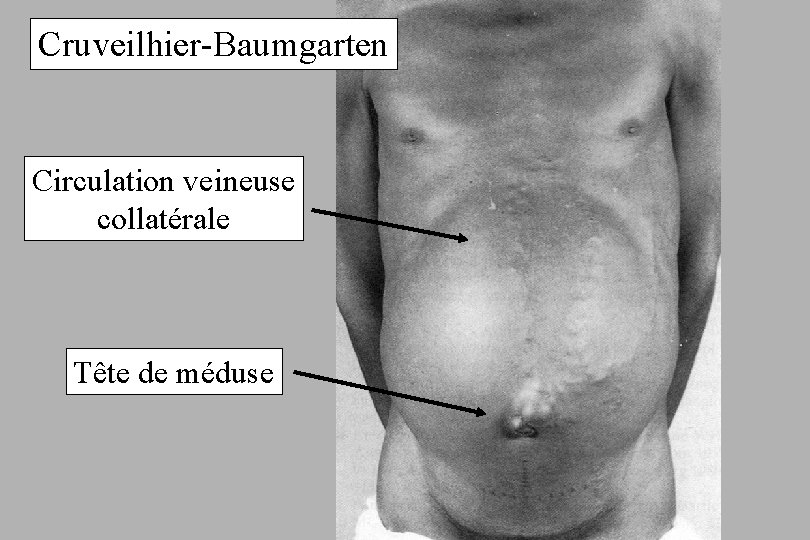 Cruveilhier-Baumgarten Circulation veineuse collatérale Tête de méduse 