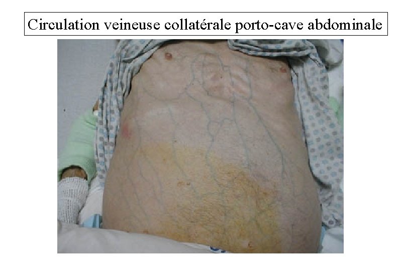 Circulation veineuse collatérale porto-cave abdominale 