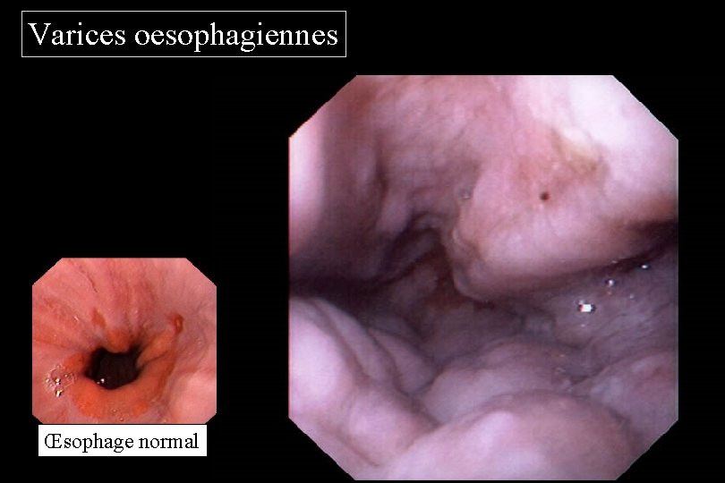 Varices oesophagiennes Œsophage normal 