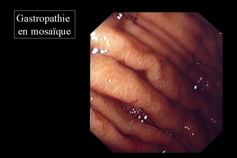 Gastropathie en mosaïque 