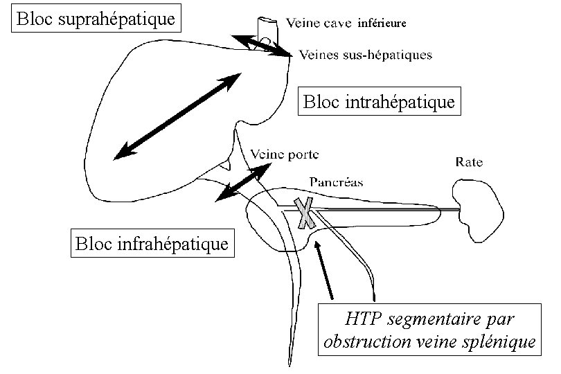 Bloc suprahépatique inférieure Bloc intrahépatique Bloc infrahépatique HTP segmentaire par obstruction veine splénique 