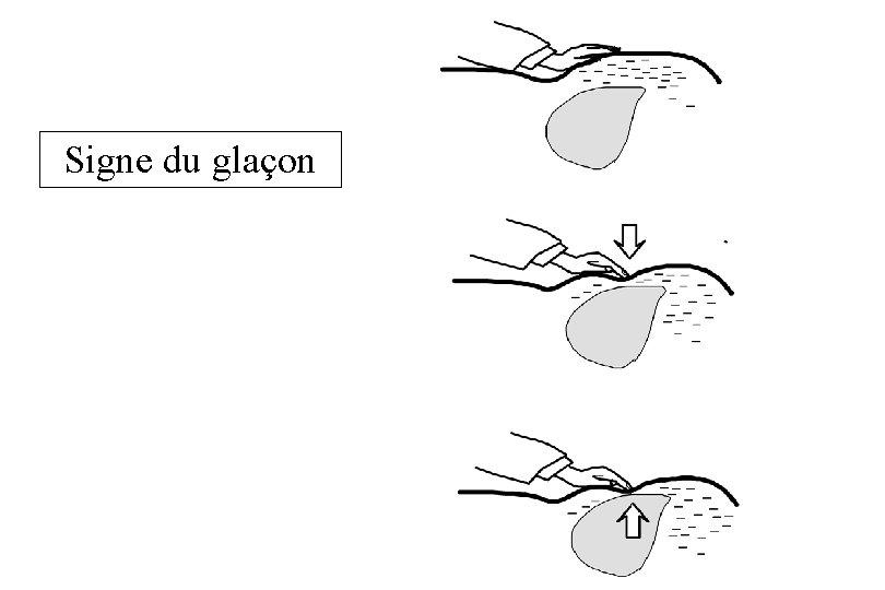 Signe du glaçon 