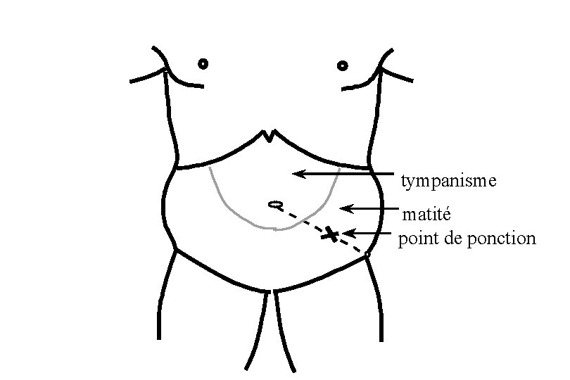 tympanisme matité point de ponction 