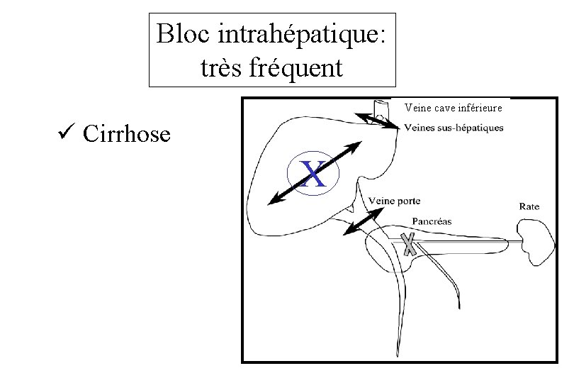 Bloc intrahépatique: très fréquent Veine cave inférieure ü Cirrhose X 