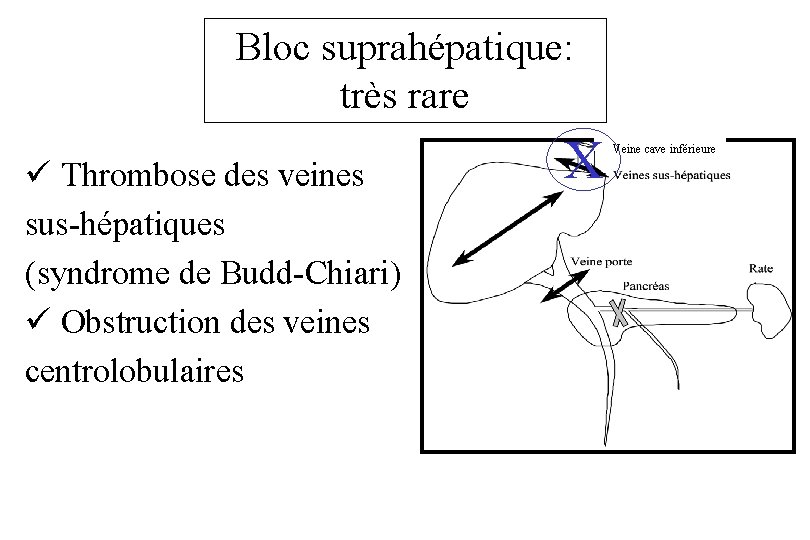Bloc suprahépatique: très rare ü Thrombose des veines sus-hépatiques (syndrome de Budd-Chiari) ü Obstruction