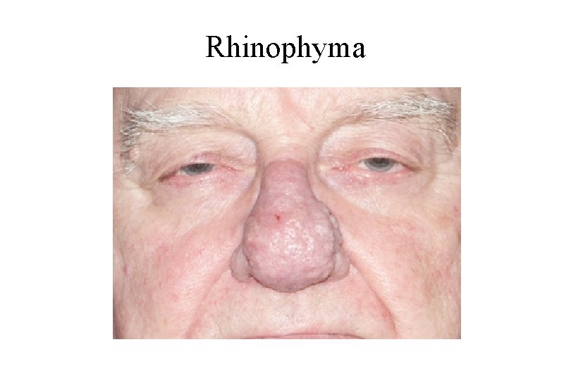 Rhinophyma 