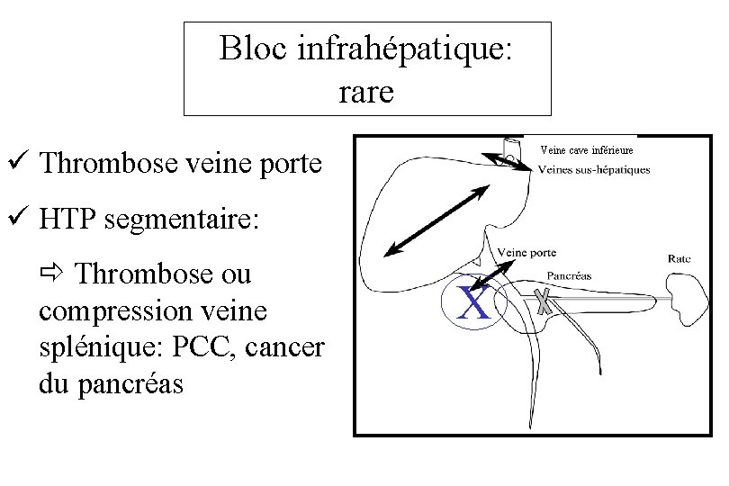 Bloc infrahépatique: rare Veine cave inférieure ü Thrombose veine porte ü HTP segmentaire: ð