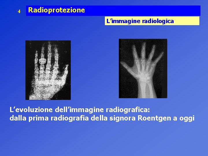 4 Radioprotezione L’immagine radiologica L’evoluzione dell’immagine radiografica: dalla prima radiografia della signora Roentgen a