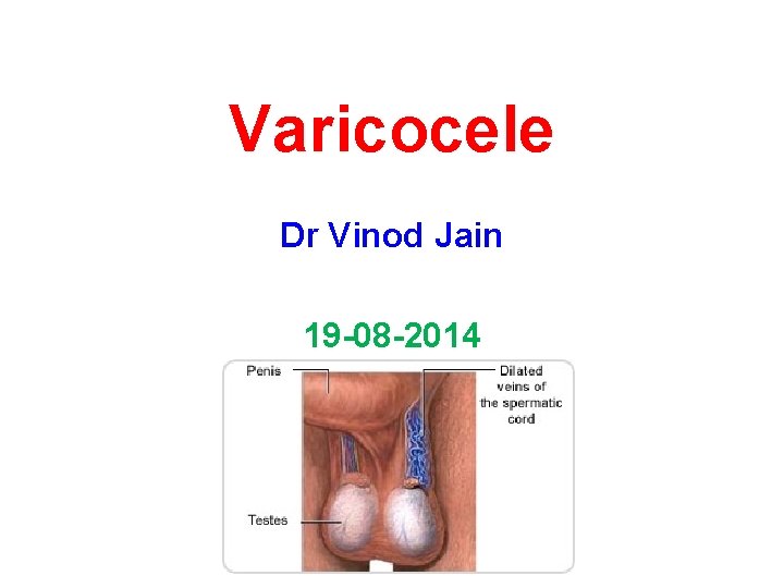 Varicocele Dr Vinod Jain 19 -08 -2014 
