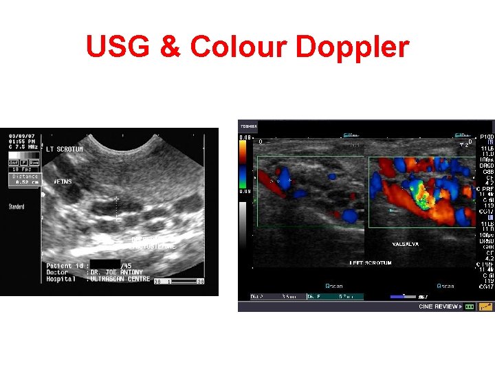 USG & Colour Doppler USG & Colour Doppler