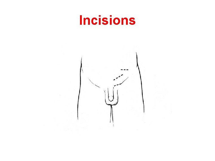 Incisions Incisions