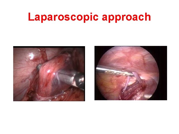 Laparoscopic approach Laparoscopic approach