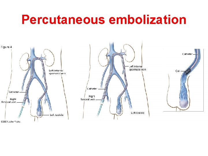 Percutaneous embolization 