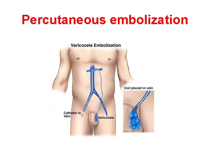 Percutaneous embolization Percutaneous embolization