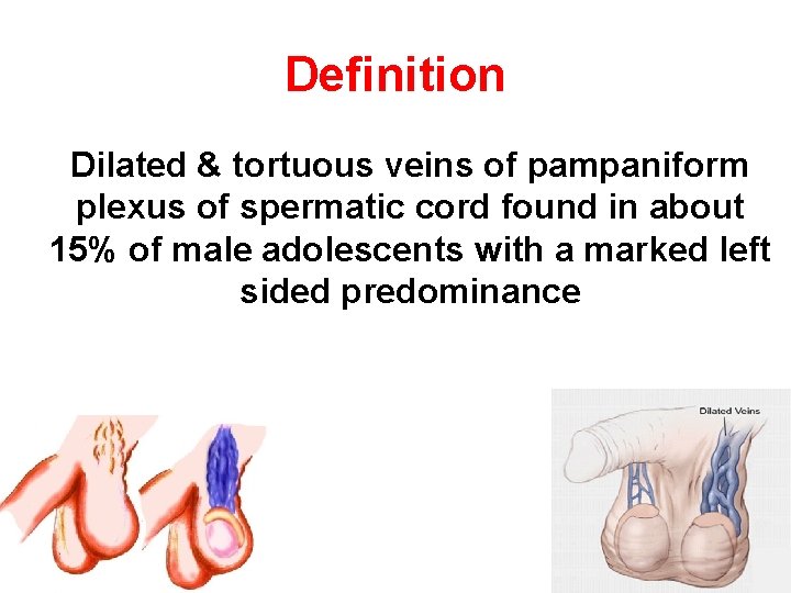 Definition Dilated & tortuous veins of pampaniform plexus of spermatic cord found in about Definition Dilated & tortuous veins of pampaniform plexus of spermatic cord found in about