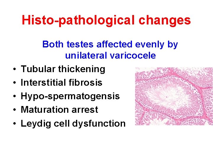 Histo-pathological changes • • • Both testes affected evenly by unilateral varicocele Tubular thickening