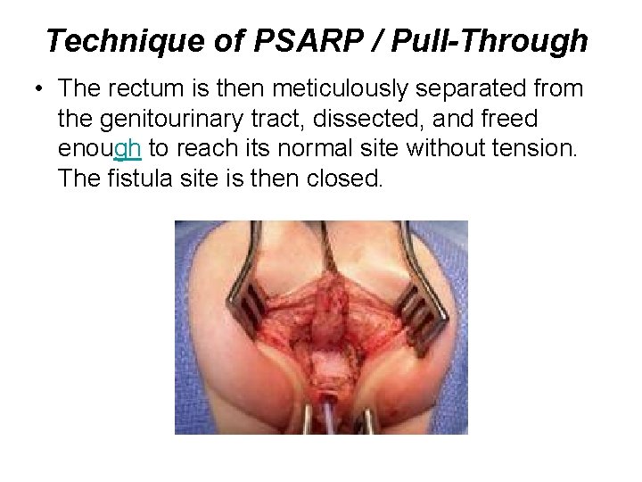 Technique of PSARP / Pull-Through • The rectum is then meticulously separated from the