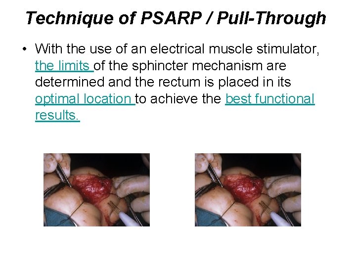 Technique of PSARP / Pull-Through • With the use of an electrical muscle stimulator,