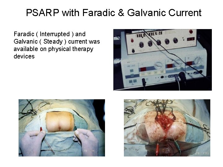 PSARP with Faradic & Galvanic Current Faradic ( Interrupted ) and Galvanic ( Steady